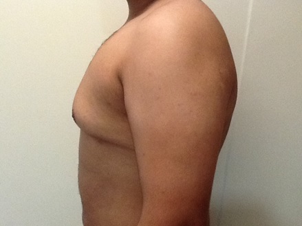 Gynaecomastia Before treatment